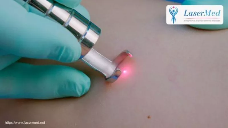 Tratamentul laser a leziunilor vasculare (telangiectazii,  capilare spa 2