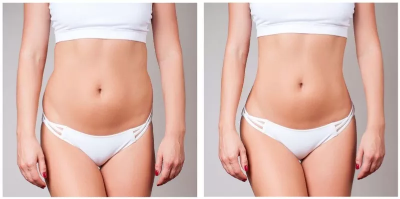 BodyTite: remodelare corporală fără bisturiu